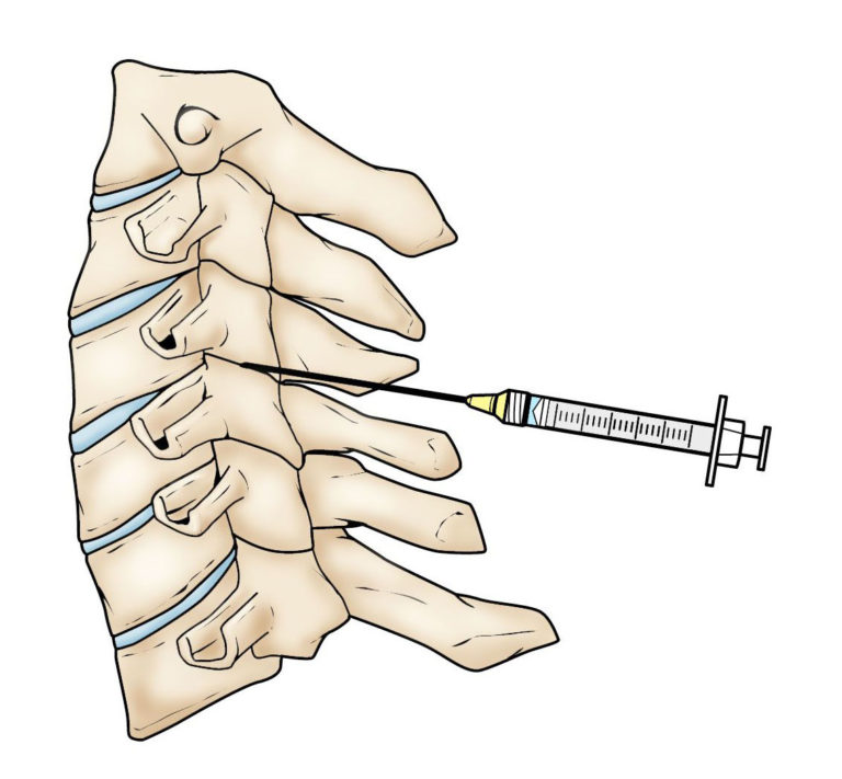 emg cervical spine