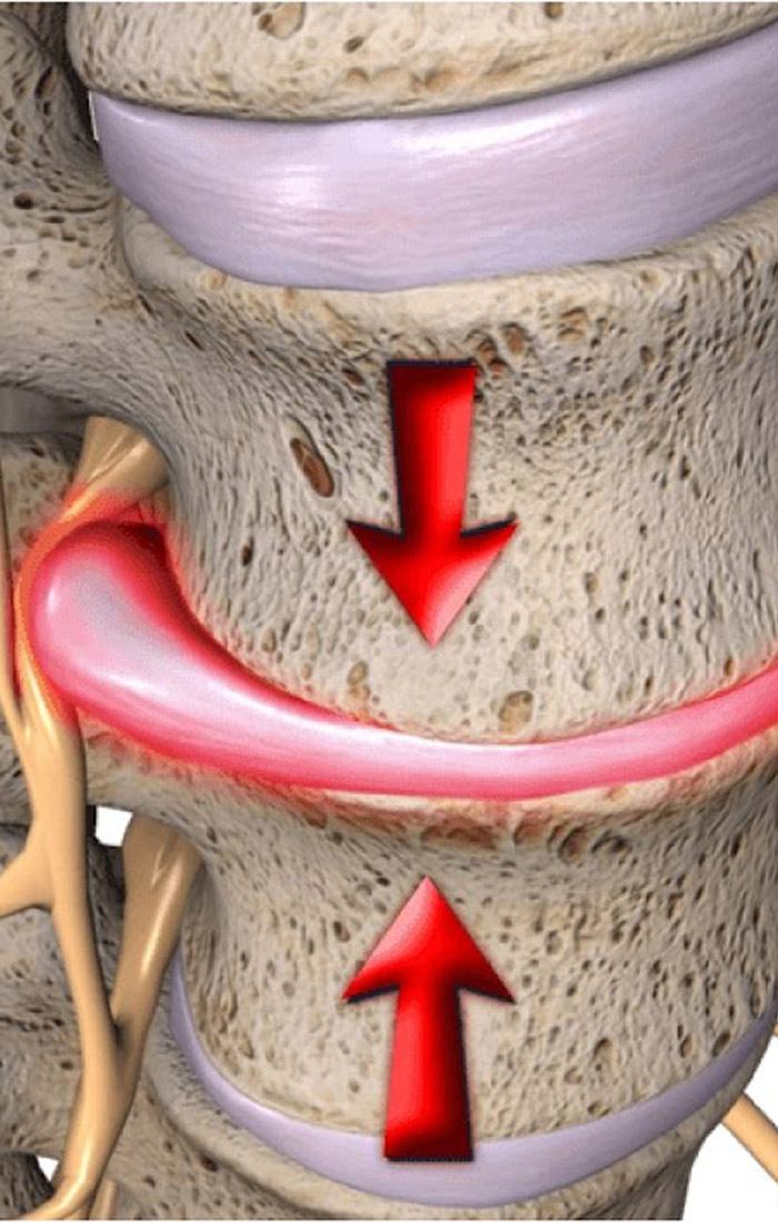 pinched nerve cause pins and needles in hands and feet pinched nerve cause pins and needles in hands and feet